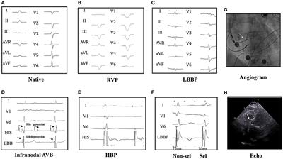 Feasibility and Outcomes of Upgrading to Left Bundle Branch Pacing in Patients With Pacing-Induced Cardiomyopathy and Infranodal Atrioventricular Block